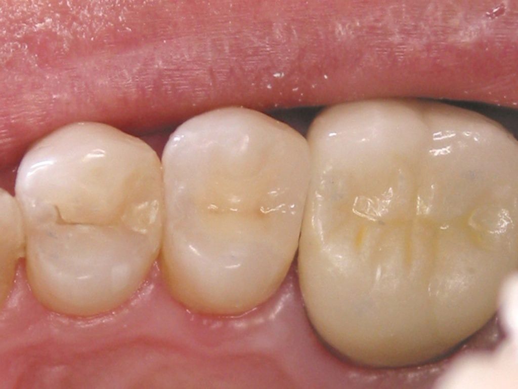 Composite ToothColored Restorations » Beverly Hills Dentist Amir
